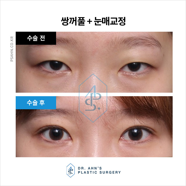함몰눈,돌출눈 쌍꺼풀 - 눈 형태에 따른 눈성형 방법 관련 이미지 3