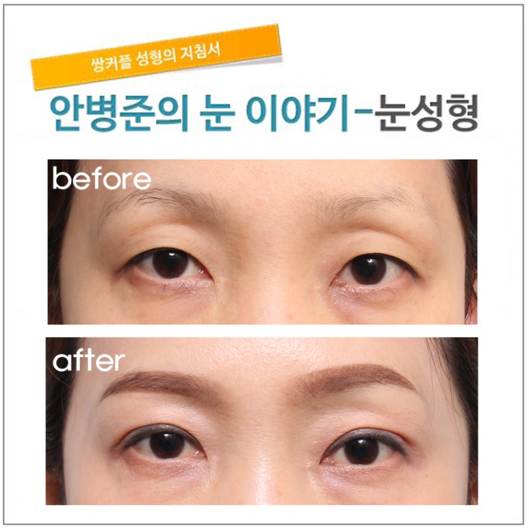 쌍꺼풀,눈매교정,지방이식(꺼진 눈) 관련 이미지 1