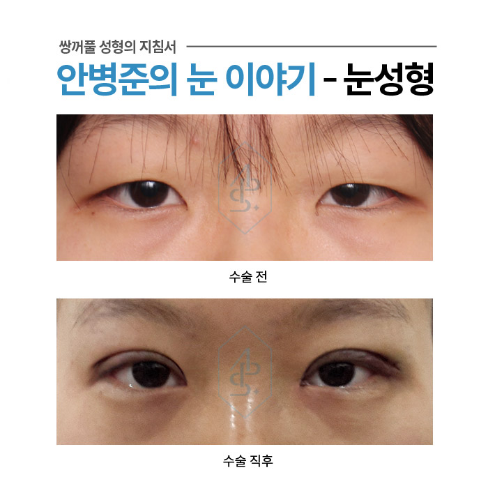 쌍꺼풀 수술에서 부기란? - 수술직후 붓기 사례 모음 관련 이미지 9