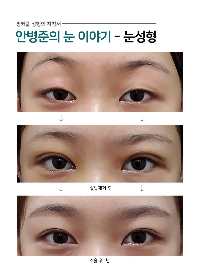 피부절제,쌍꺼풀수술(절개법,쌍수) 관련 이미지 1