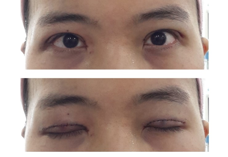 삼백안 교정 관련 이미지 2