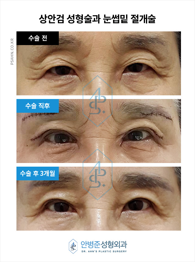 [방배역성형외과] 처진 눈꺼풀 피부를 해결하는 수술? 관련 이미지 1