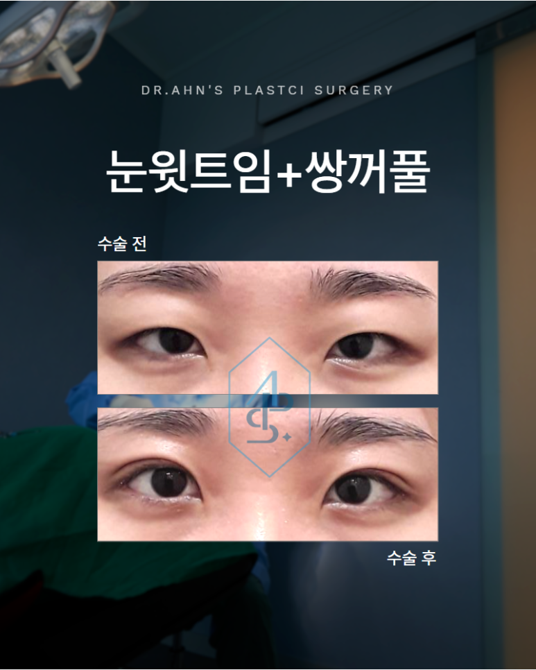 눈윗트임 쌍꺼풀 함께 진행하여 나타난 시너지 효과 관련 이미지 1