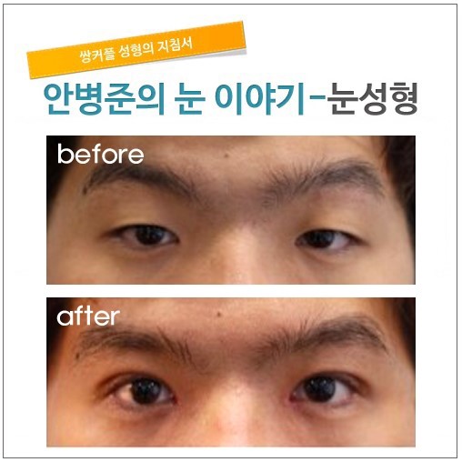 5일 실밥제거후. 관련 이미지 1