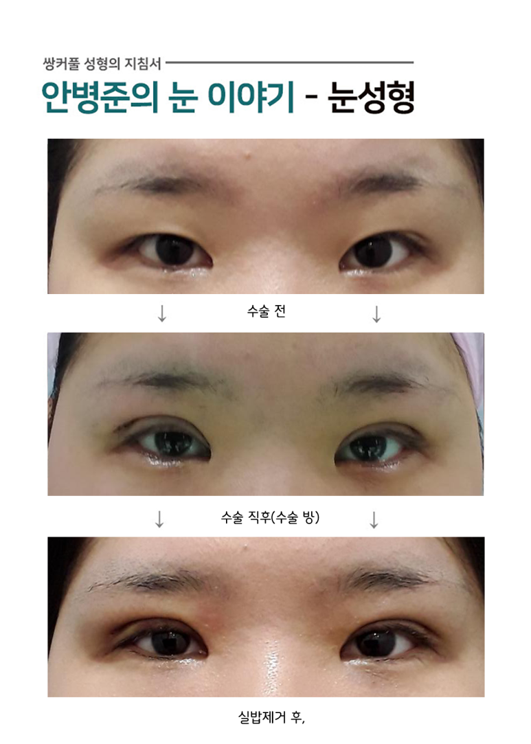 짝 눈,짝짝이 눈(피부절제) 관련 이미지 1