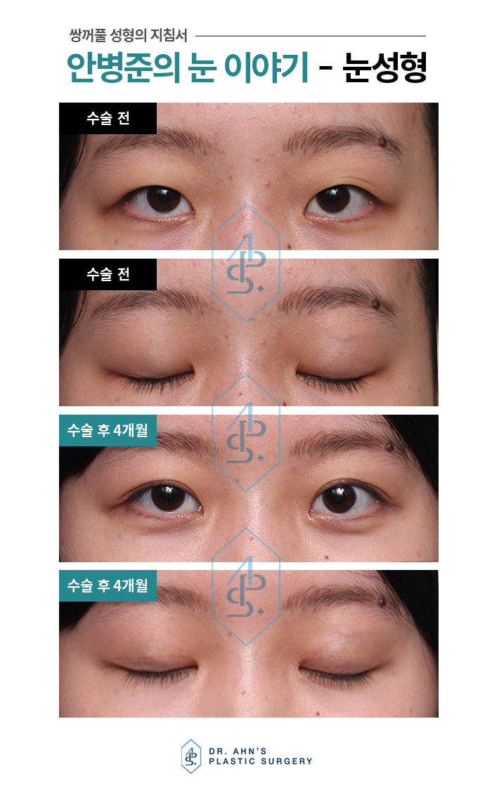 [안검하수성형외과] 잘못 알고 있는 가짜 안검하수 관련 이미지 4