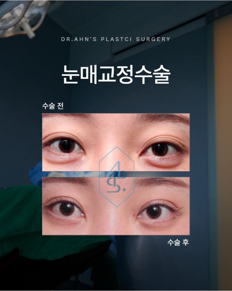 When Double-Eyelid Surgery Alone Is Not Enough for Creased Folds and Sunken Eyelids: Eye-Opening Correction Surgery image 1