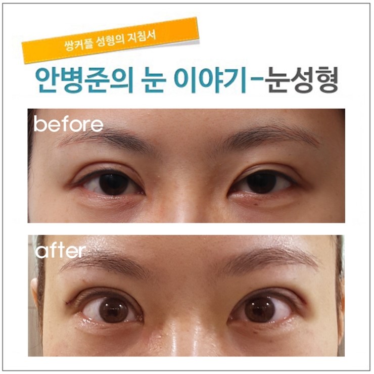 high fold(큰 쌍꺼풀)줄이기.(쌀꺼풀라인줄이기) 관련 이미지 1