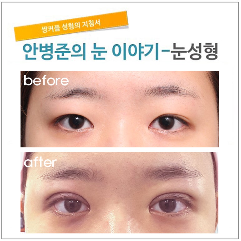 1년전  매몰법 수술풀려 재수술후 또다시 풀려 내원한 케이스 관련 이미지 1