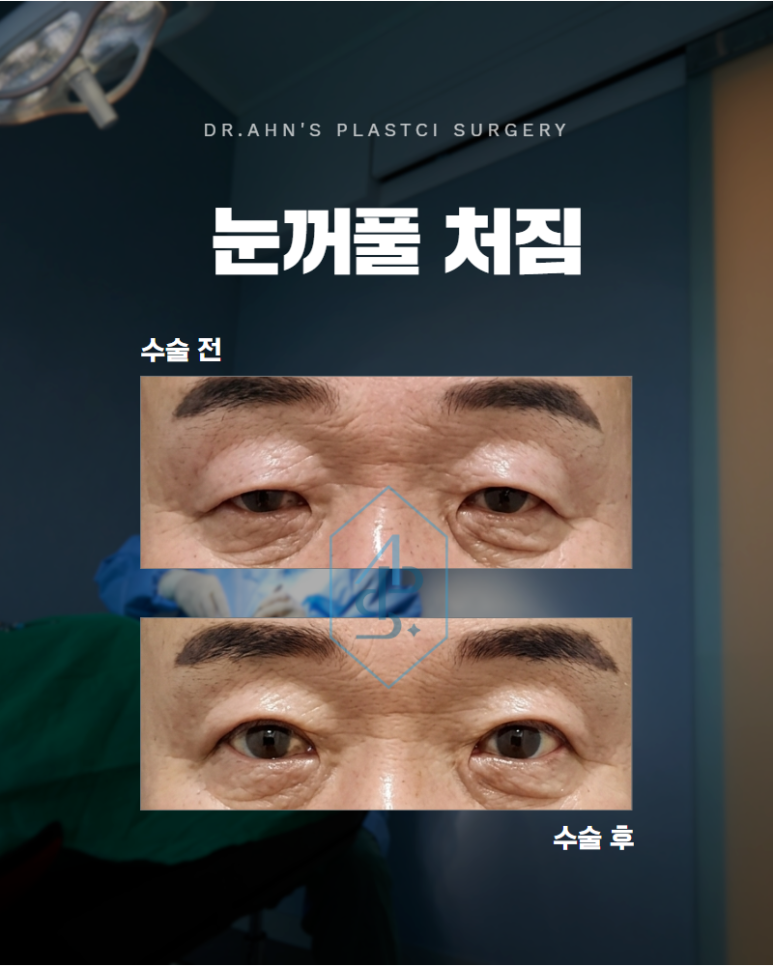눈꺼풀 처짐 이마 거상이 정답일까요 관련 이미지 1