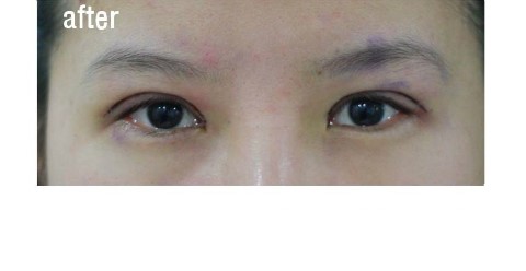 수술 직후.   [안병준의 눈이야기] 관련 이미지 2