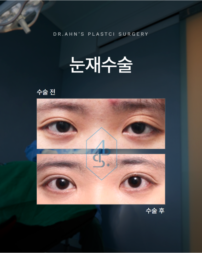 눈재수술성형외과 여러 번 수술 후에도 남아있는 고민이라면 관련 이미지 1