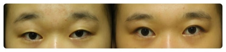 안병준의 쌍꺼풀 지침서 08_한국인의 눈꺼풀 모양 관련 이미지 3