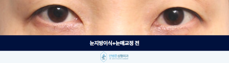 눈지방이식 꺼진 눈꺼풀 자연스럽게 채울 수 있을까요 관련 이미지 2