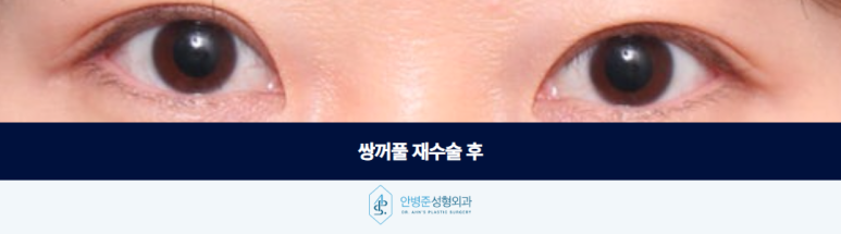 If Your Double Eyelid Line Has Become Hidden Over Time: Revision Surgery image 3