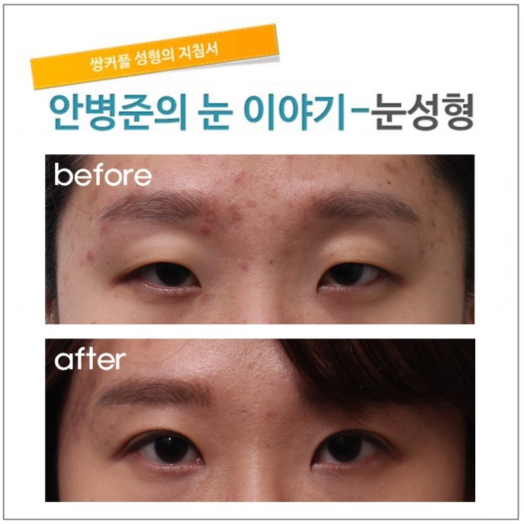 경미한 안검하수와 꺼진 눈꺼풀. 관련 이미지 1