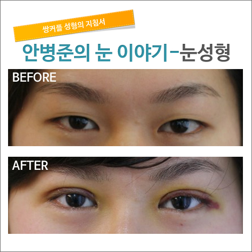 쌍커풀수술 경과_1개월후 관련 이미지 1