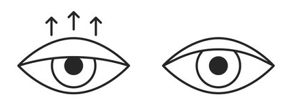 [강남성형외과]상안검성형술 및 눈밑지방재배치 사례 관련 이미지 2