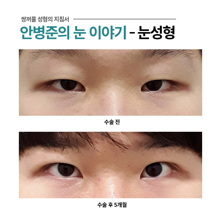 눈꺼풀 처짐,안검하수 교정방법은 상안검? 눈매교정? 관련 이미지 1
