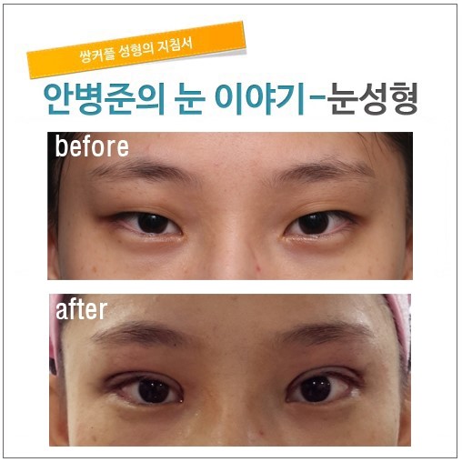 부드러운 눈으로 고치기 관련 이미지 1