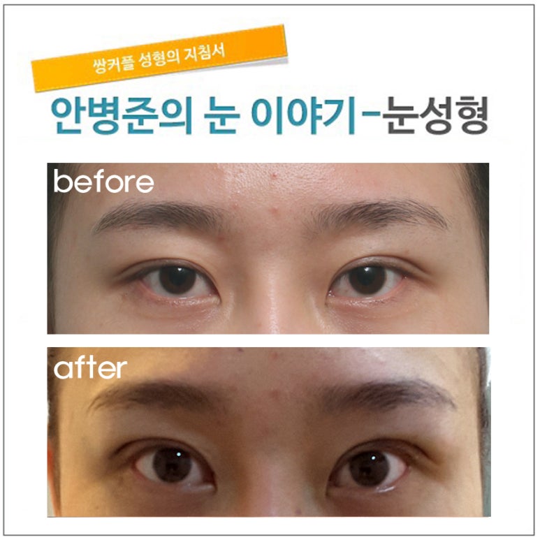 4년 전 수술 재수술(삼백안,재수술,눈매교정) 관련 이미지 1