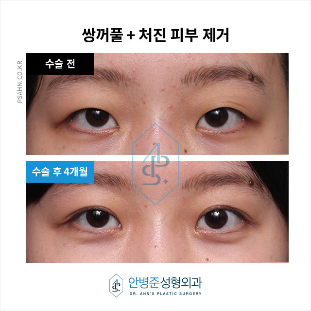 [눈성형] 가짜 안검하수, 불필요한 눈매교정 피하는 방법 관련 이미지 1
