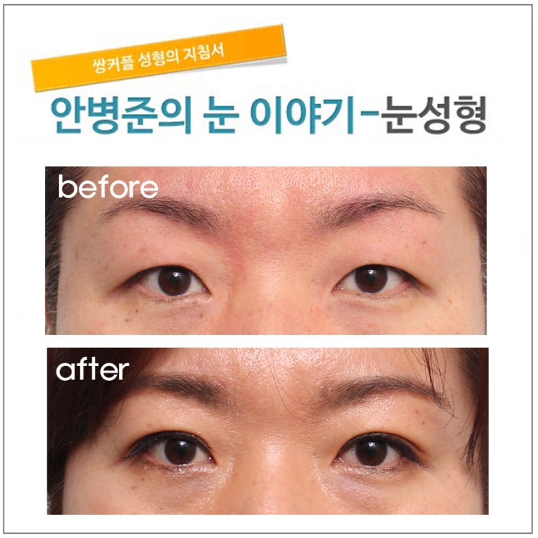 가장 교과서적인 상안검성형술(상안검술,상안검성형술) 관련 이미지 1