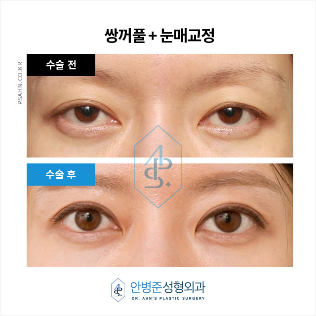 눈두덩이에 지방이 부족하다? 당신은 꺼진눈입니까? 관련 이미지 3