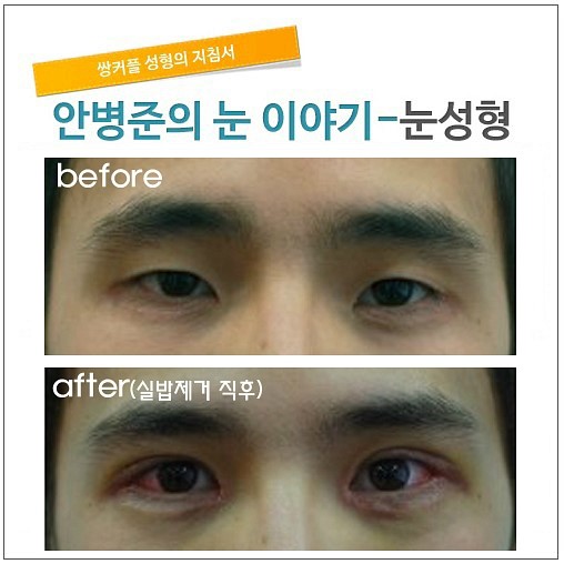 쌍꺼풀,눈매교정,앞트임,뒷트임,5일째 관련 이미지 1