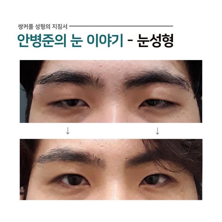 안검하수와 처진 피부가 공존하는 전형적인 남자 눈(눈매교정,피부절제) 관련 이미지 1