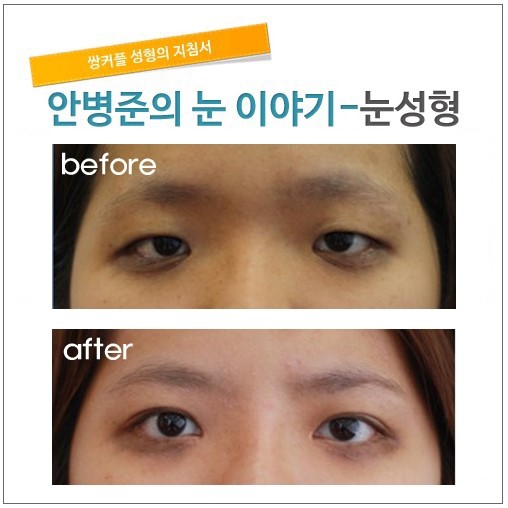 2주경과후.    [안병준의 눈이야기] 관련 이미지 1