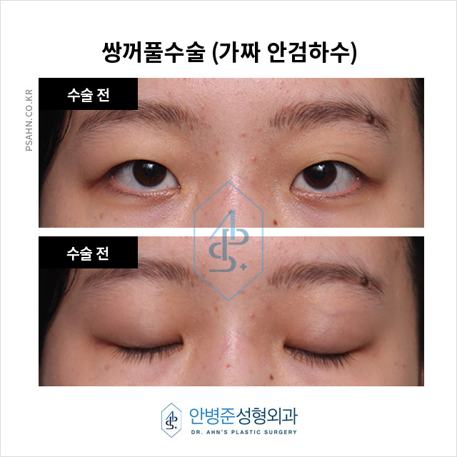 [가짜안검하수] 자연스러운 눈매를 위한 쌍꺼풀 수술과 피부 처짐 개선 효과 관련 이미지 1