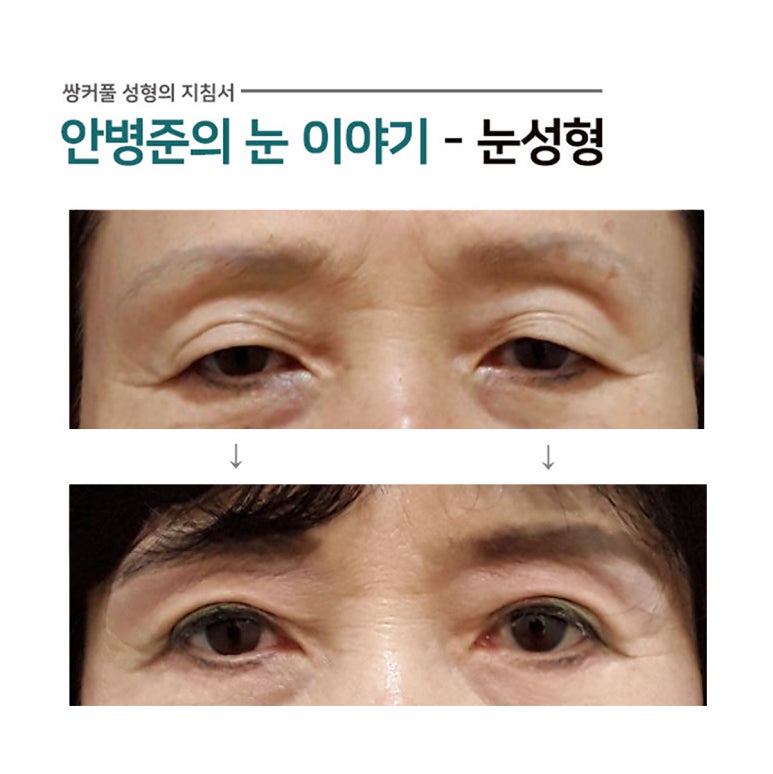 상안검성형술,하안검성형술 관련 이미지 1