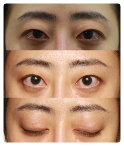 -쌍꺼풀 라인크기의 중요성-                [안병준의 눈이야기] 관련 이미지 2