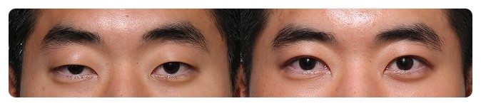 안병준의 쌍꺼풀 지침서4_쌍꺼풀수술 왜 하는가? 관련 이미지 6