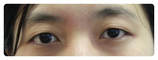 -자연스런 쌍꺼풀이 뭘까??-          [안병준의 눈이야기] 관련 이미지 1