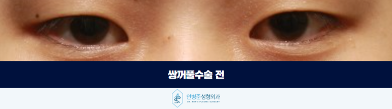 쌍꺼풀수술 자연스러운 눈을 만들기 위한 중요한 기준 관련 이미지 2