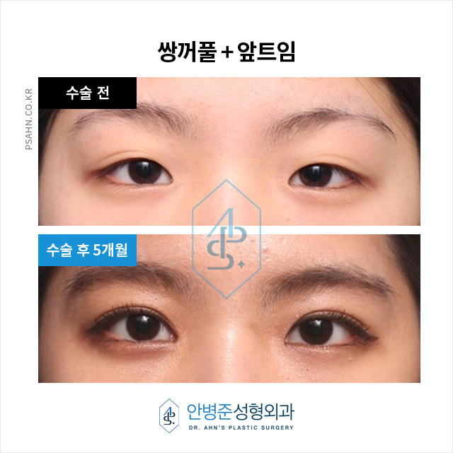 눈꺼풀의 지방과 근육을 적당량 제거하는 두툼한 눈 관련 이미지 4