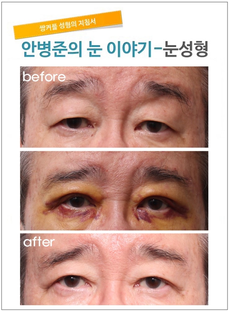 70대 상안검성형술 관련 이미지 1