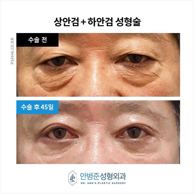 [상안검,하안검]100세 시대, 남성 상하안검성형술의 새로운 관심 관련 이미지 9