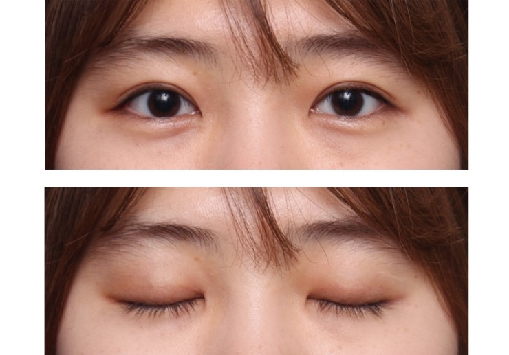 혹 안검하수는 아닌지? 관련 이미지 3