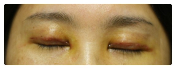 -소시지눈 고치기 과정-        [안병준의 눈이야기] 관련 이미지 11