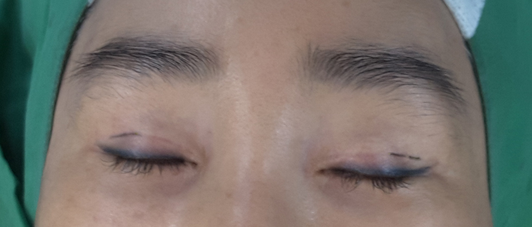 효과 좋은 지방이식 방법 관련 이미지 3