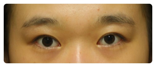 쌍꺼풀과 눈매교정 6개월후.      [안병준의 눈이야기] 관련 이미지 2