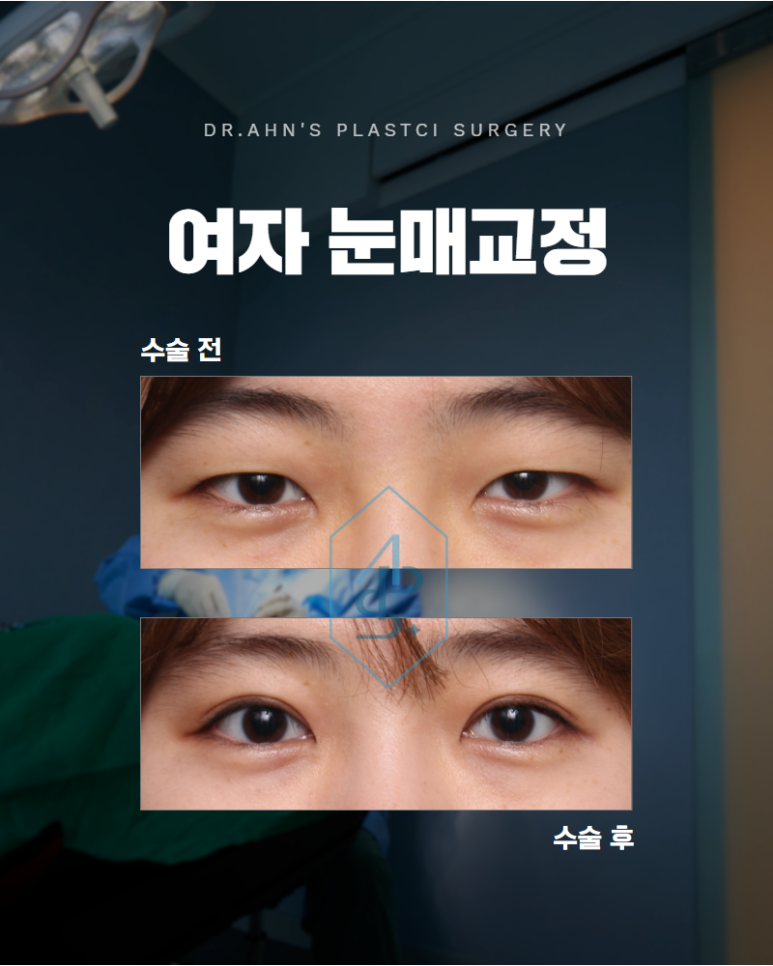 여자 눈매교정 안검하수 또렷하면서도 부드러운 인상을 찾다 관련 이미지 1
