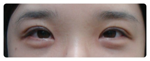 쌍커풀수술 4개월째 경과 관련 이미지 3