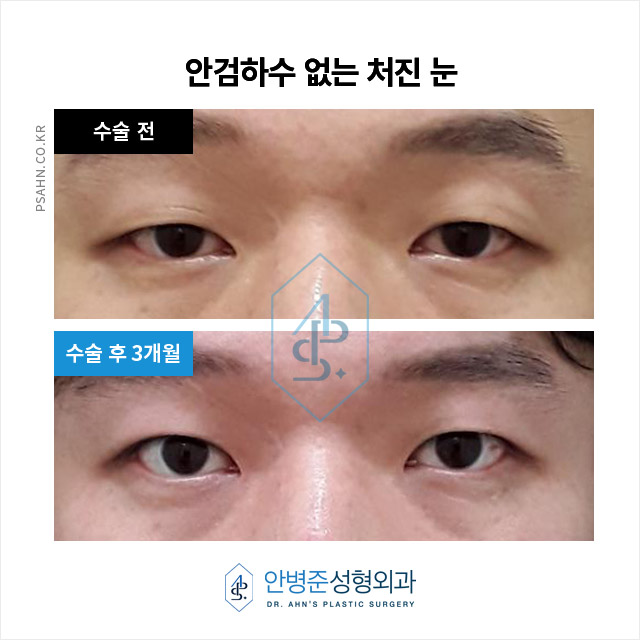 [남자눈성형] 남자 쌍꺼풀, 여자와 다른 자연스러움의 포인트? 관련 이미지 3