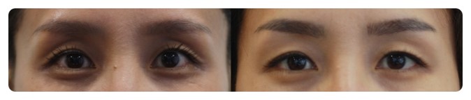 안병준의 쌍꺼풀 지침서4_쌍꺼풀수술 왜 하는가? 관련 이미지 4