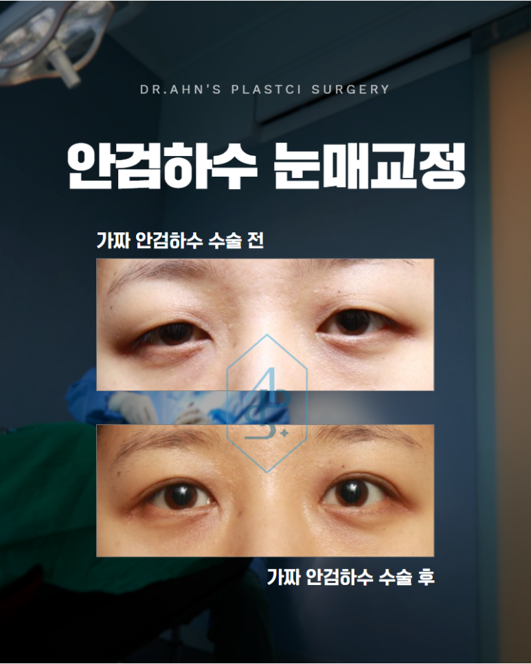 안검하수 눈매교정 가짜와 진짜를 구분해야 합니다 관련 이미지 1