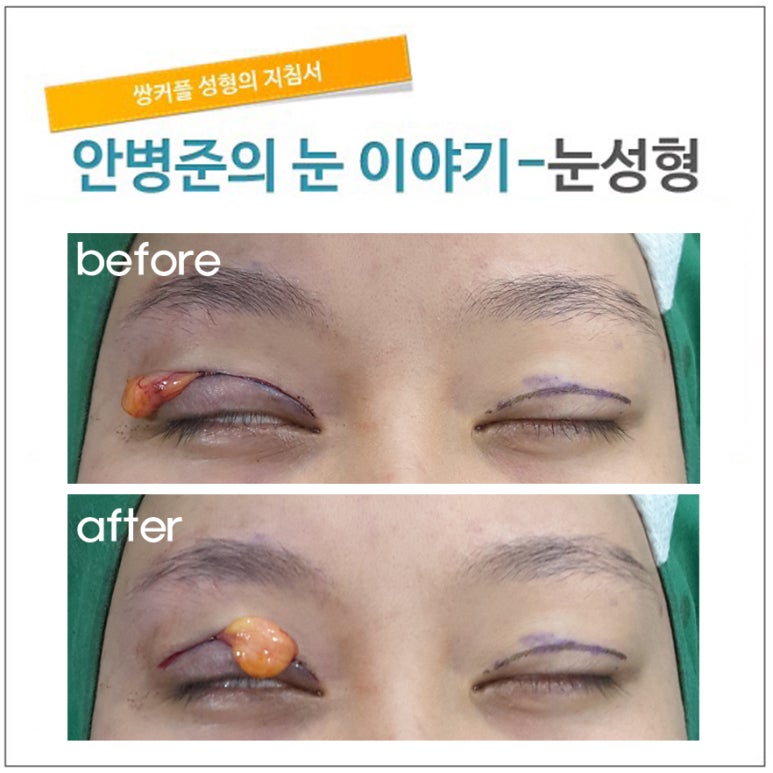 돌출눈 관련 이미지 1